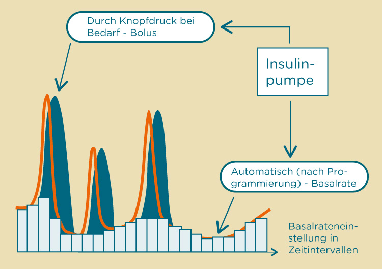 Insulinabgabe mit der Insulinpumpe Insulinabgabe mit der Insulinpumpe
