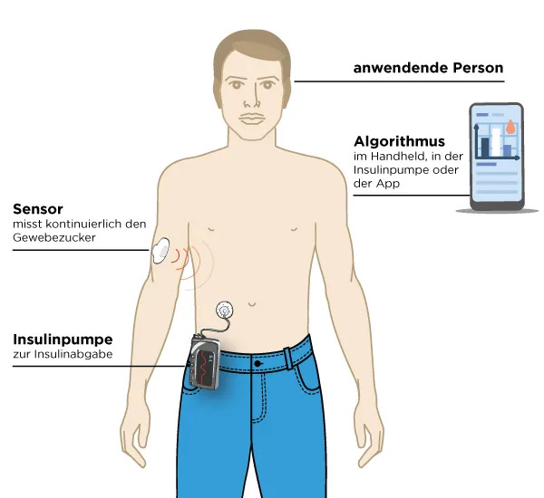 Das AID-System mit seinen Komponenten Das AID-System besteht aus einer Insulinpumpe, einem CGM-System, einem Algorithmus und der anwenden Person